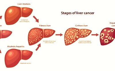 October as Liver Cancer Awareness month: all you need to know about Hepatocellular carcinoma